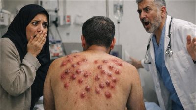 وجدتُ ثلاثين بقعة حمراء على ظهر زوجي تشبه بيض الحشرات